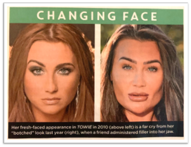 CLOSER Magazine: Lauren Goodger’s filler scandal: ‘You could BLIND ...