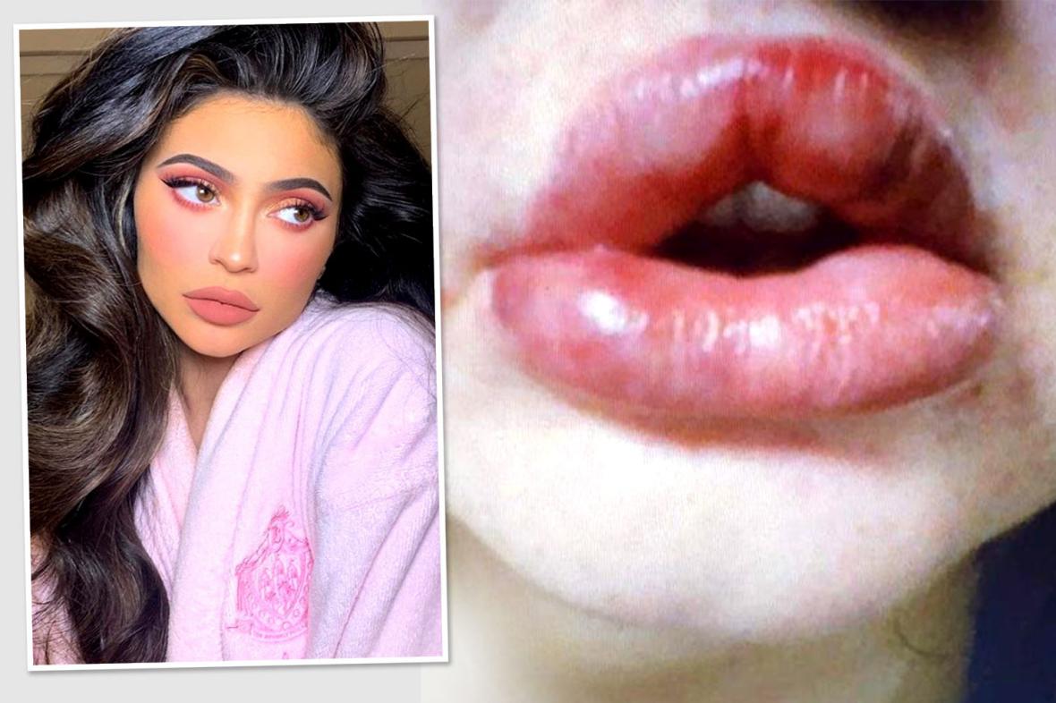 Molly-Mae Hague details 'horrible' truth about lip fillers as she