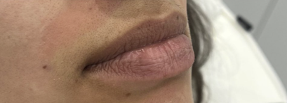 before lips1.png