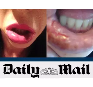 20 women Come Forward to Claim They Were Maimed by Unlicensed Doctor in Lip Fillers Scandal