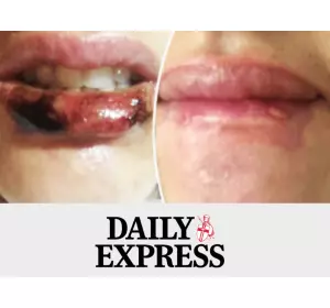 Save Face in the Express: 'I nearly lost my lips' Warning to women as Kardashian look treatments go horribly wrong