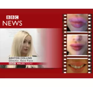 BBC NEWS: The Risks of Lip Fillers in Unsafe Hands
