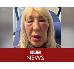 BBC News - 'I paid a fake doctor thousands for fillers - now I look like a gargoyle'